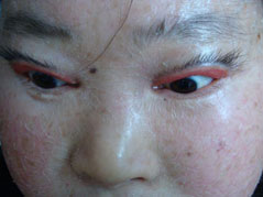 层板状鱼鳞病症状