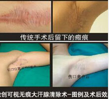 腋臭微创清除术治疗过程