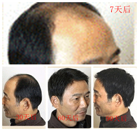 遗传性脱发怎么治疗比较好