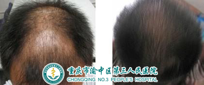 脱发治疗前后对比